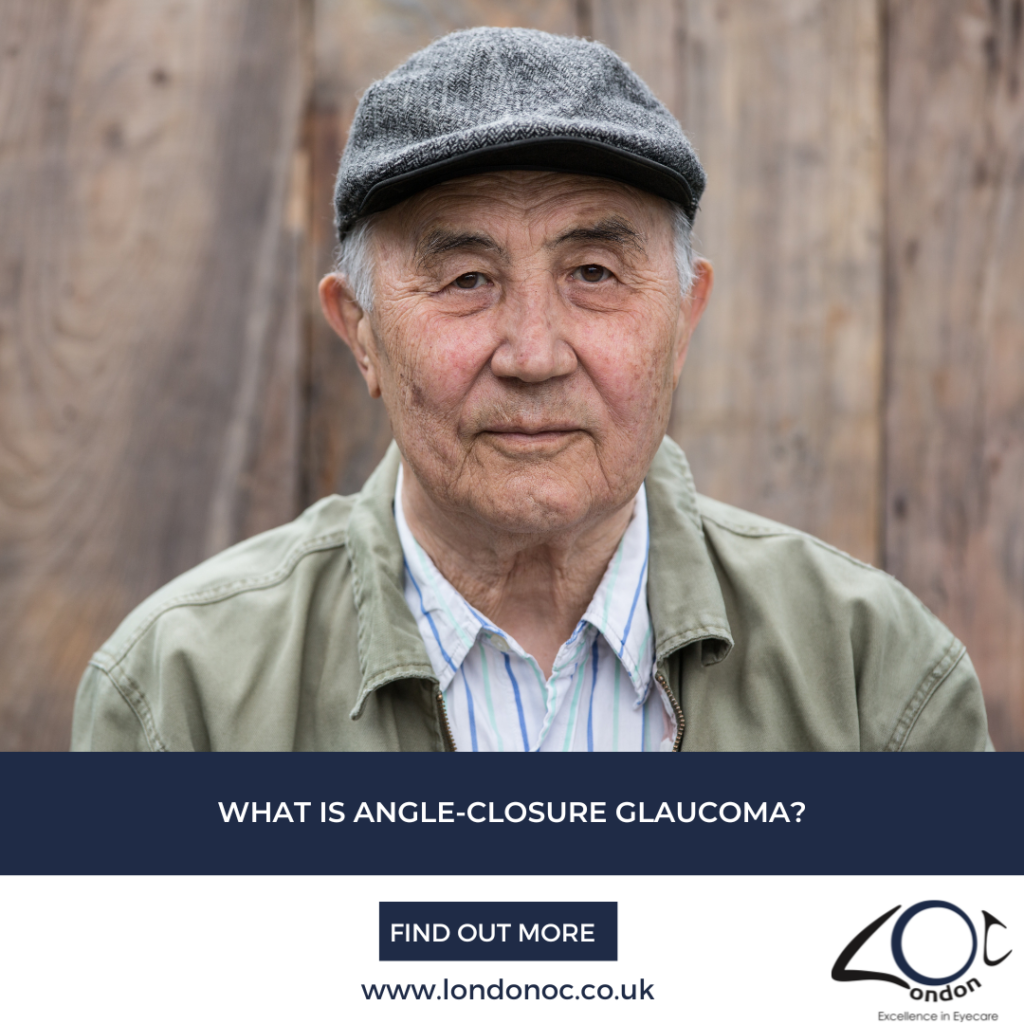 Angle-Closure Glaucoma - LondonOC - Glaucoma