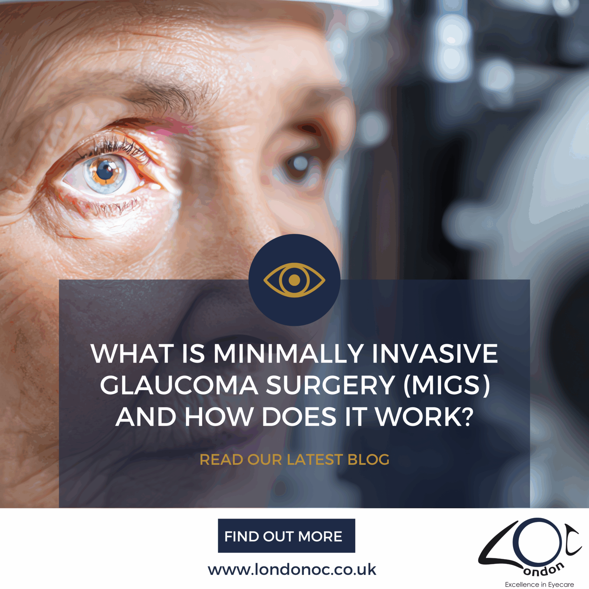 What is minimally invasive glaucoma surgery (MIGS) - LondonOC