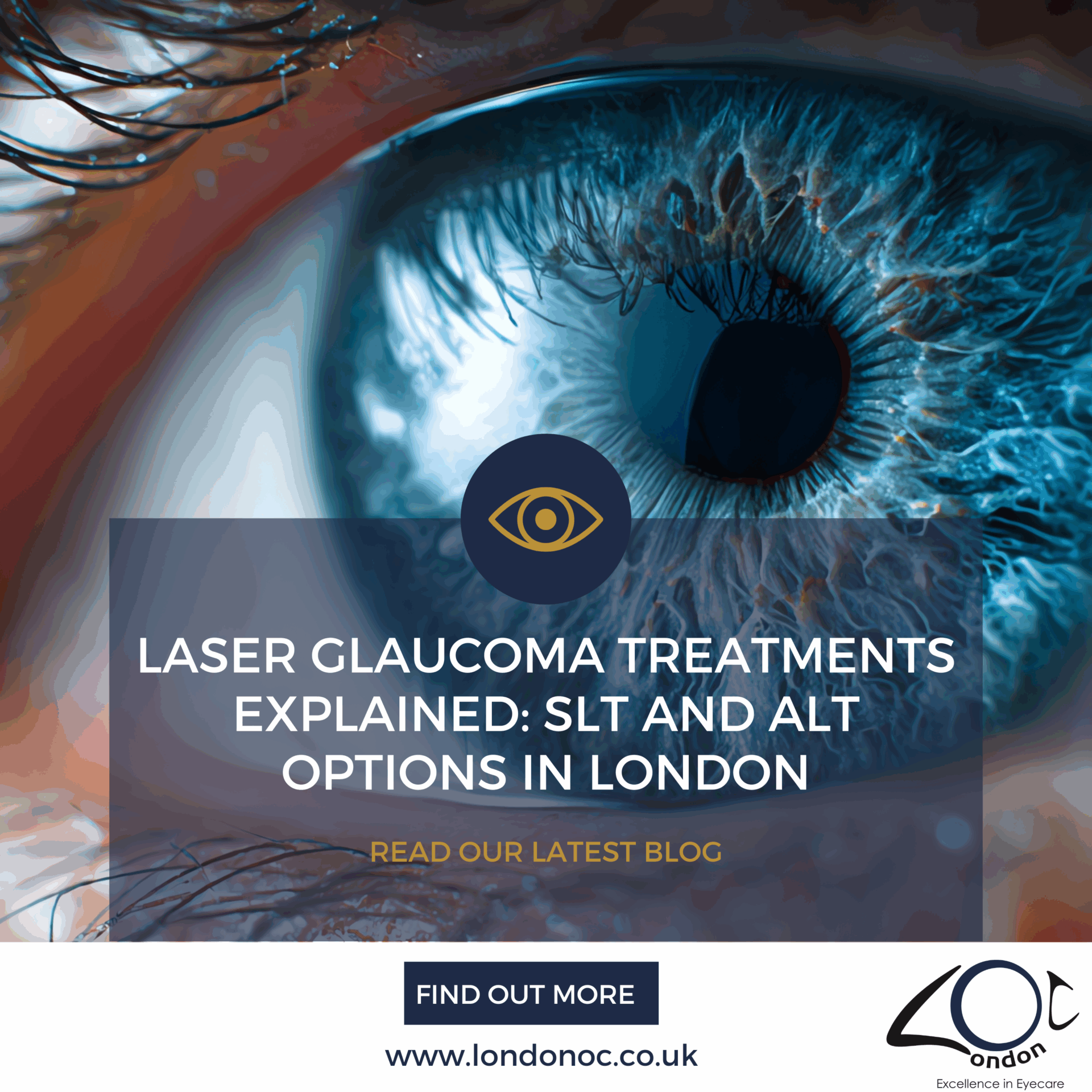 Laser glaucoma treatments explained - LondonOC