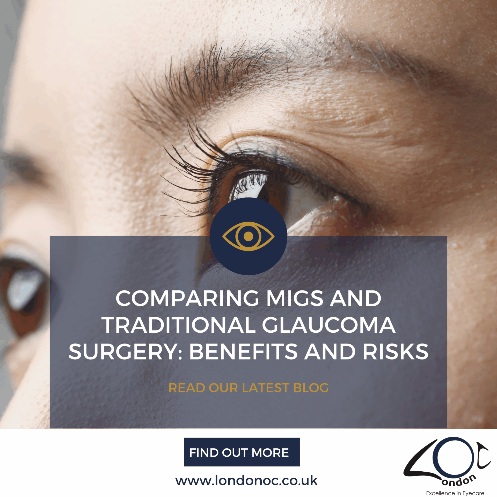 Comparing MIGS and traditional glaucoma surgery - LondonOC