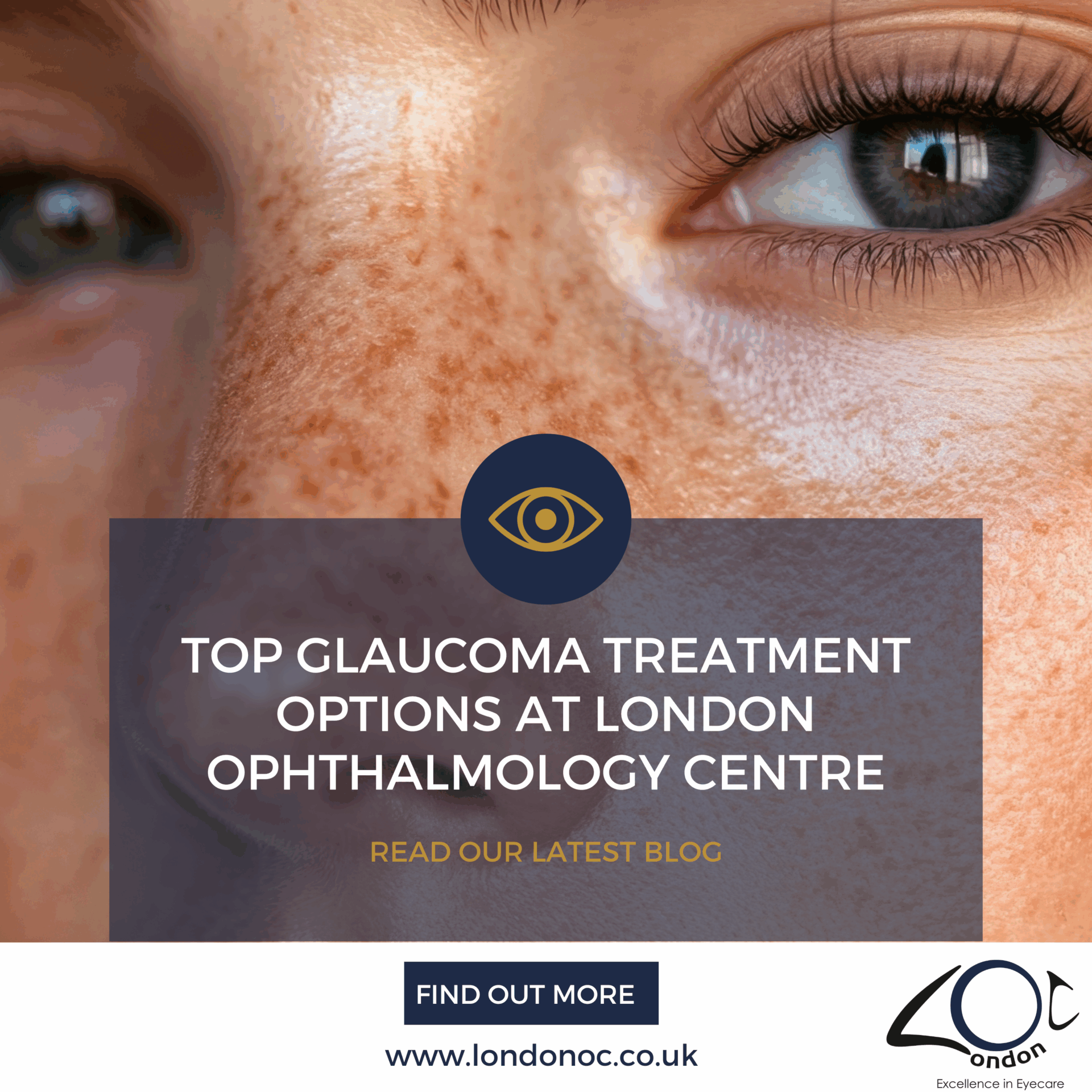 Top glaucoma treatment options at London Ophthalmology Centre